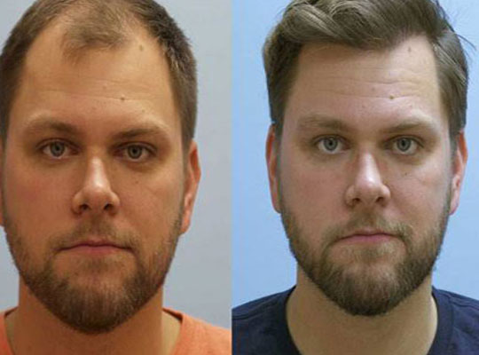 hair patch center in jaipur